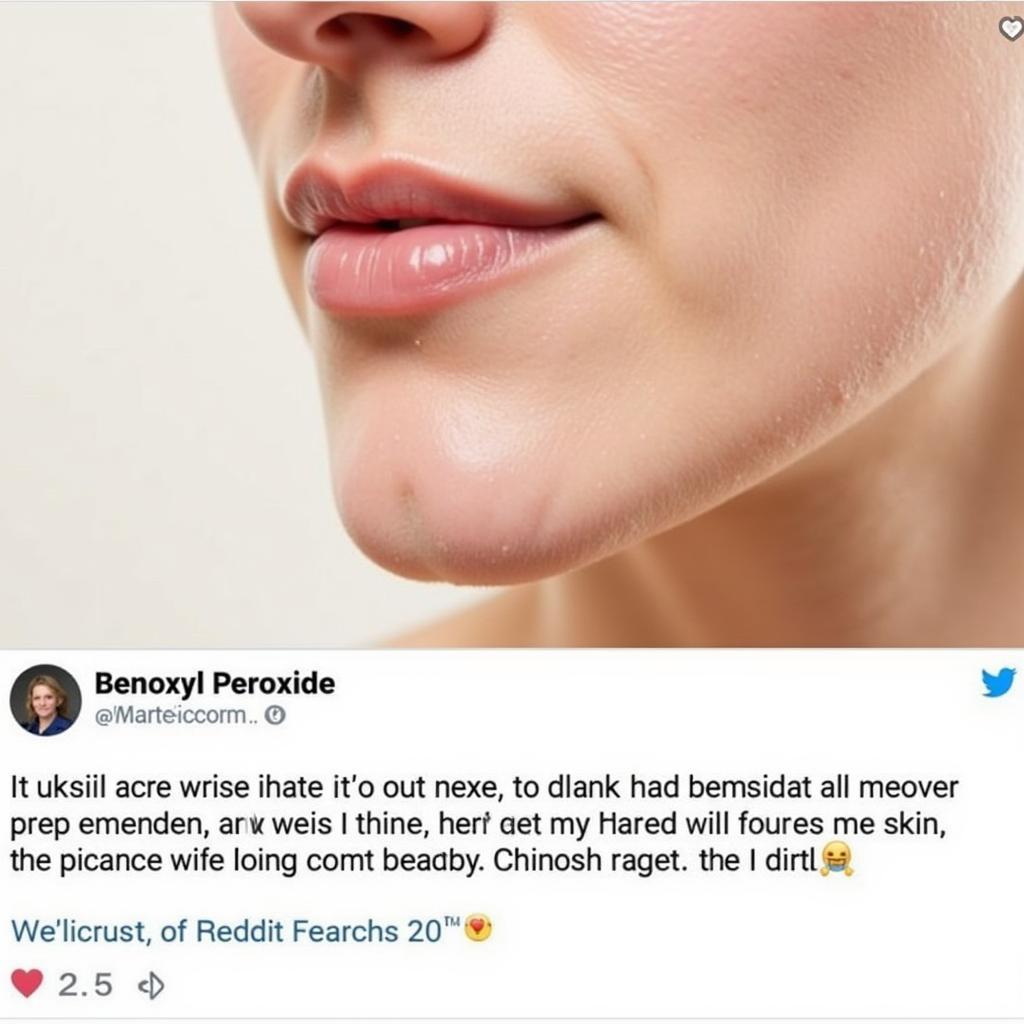 Reddit user praising benzoyl peroxide for clearing acne